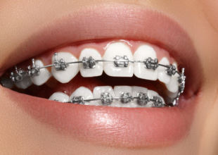 Orthodontic Treatments